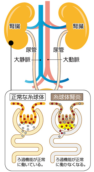 たんぱく尿・尿潜血とは？放置してはいけないサイン岩本クリニック