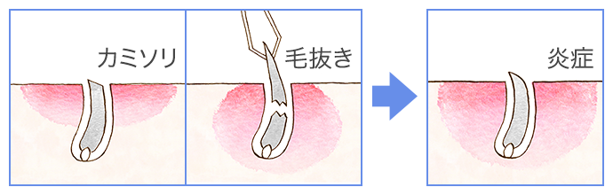 毛包炎は、何よりも清潔にすることが大切です。 シャワーを適宜浴びたり、抗菌石けんを使用するなどし、清潔を心がけましょう🧼中々自然治癒しなかったり、徐々に範囲が広がっていたりする場合は皮膚科での診察を受けましょう