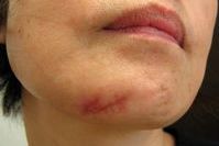 美肌 傷跡修正・ケロイド治療 の症例写真症例写真集共立美容外科宇都宮院 栃木県宇都宮市の美容外科・美容皮膚科 美容整形