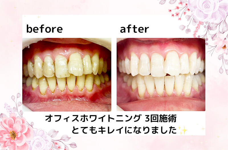 クリーニング・ホワイトニングあらい歯科医院 公式 インプラント 矯正歯科