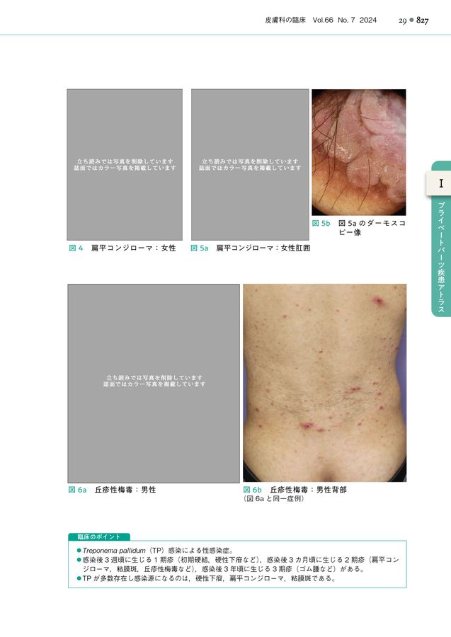 尖圭コンジローマについてみうら泌尿器科クリニック