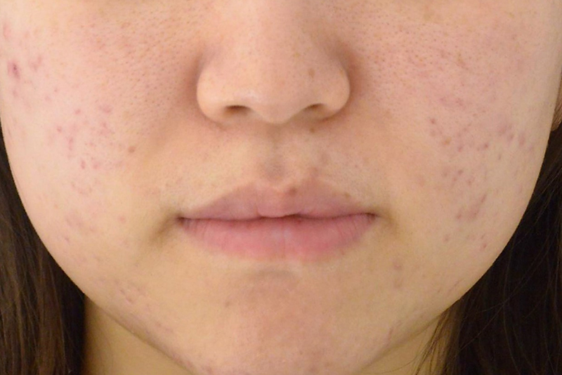 炎症後色素沈着