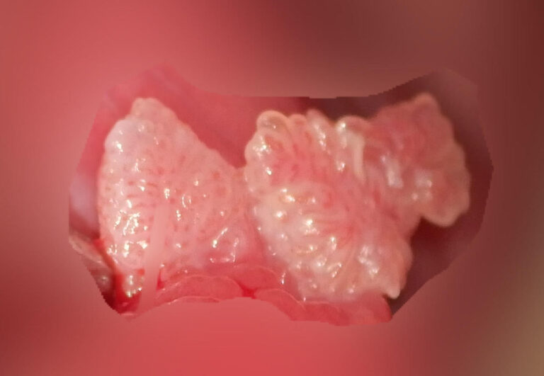 尖圭コンジローマの説明スライド - 医療のイラスト・写真・動画、素材販売サイトのメディック medick