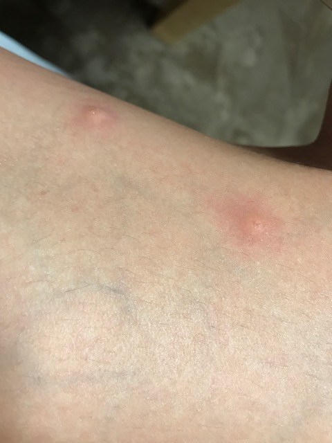 虫さされチェックアース害虫駆除なんでも事典