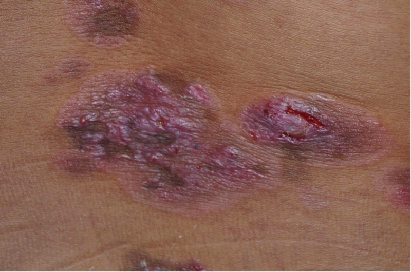 64 リンパ腺が腫れる病気 細菌感染やがんの転移 - 琉球新報デジタル