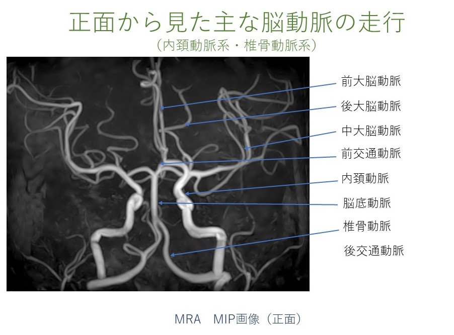 MRA ウィリス動脈輪 脳血管の探し方のポイント！！＃Circle of Willis 理学療法士国家試験・作業療法士国家試験PT・OT・ST・看護師 ＃理学療法士 ＃作業療法士 ＃国試 - YouTube