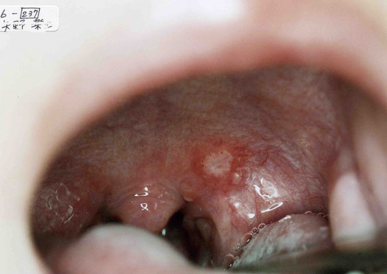 ヘルパンギーナかわごえファミリークリニック ブログ