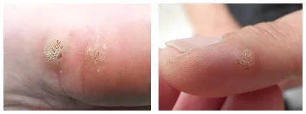 イボの種類や取り方やってはいけないことは？豊中の千里皮膚科