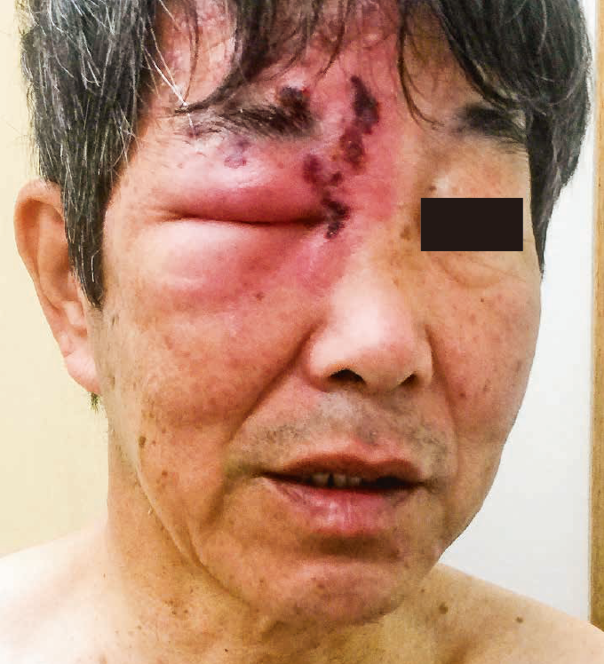 吹田市で帯状疱疹の治療なら江坂駅前花ふさ皮ふ科