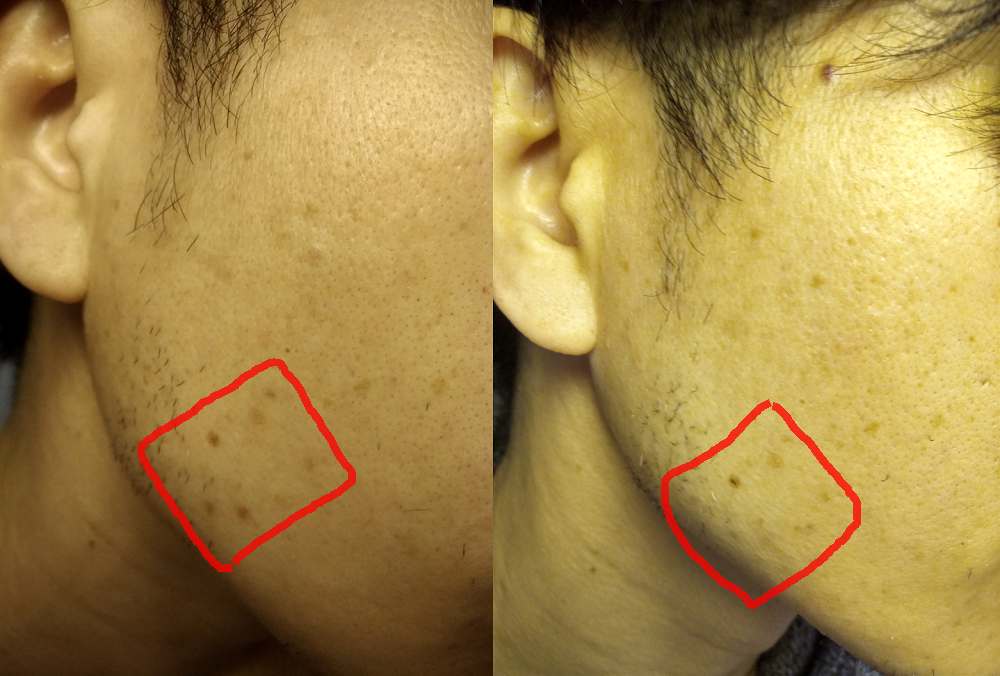 ケノン「ヒゲ脱毛」その後７ヶ月実施後の状態 脱毛中自分で脱毛ドットコム