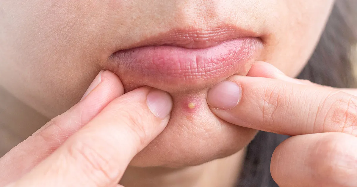 ニキビには何種類ある？タイプ別の治し方を知ろう