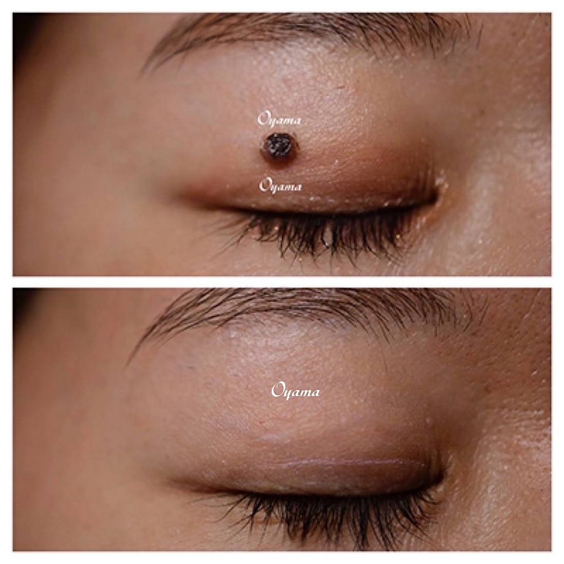 ホクロ除去 レーザー+手術