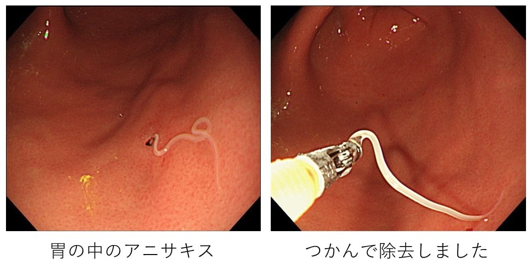 十二指腸アンシロストマ ベクトル科学図