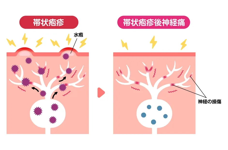 帯状疱疹ヘルペスウイルス ー帯状疱疹の一般経過ー大阪市住吉区あびこ駅前の肛門外科 むらやま大腸肛門クリニック