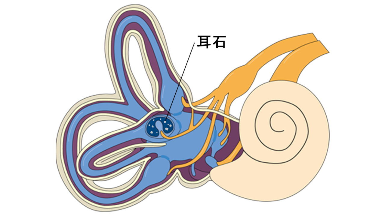 良性発作性頭位めまいの症状や治療