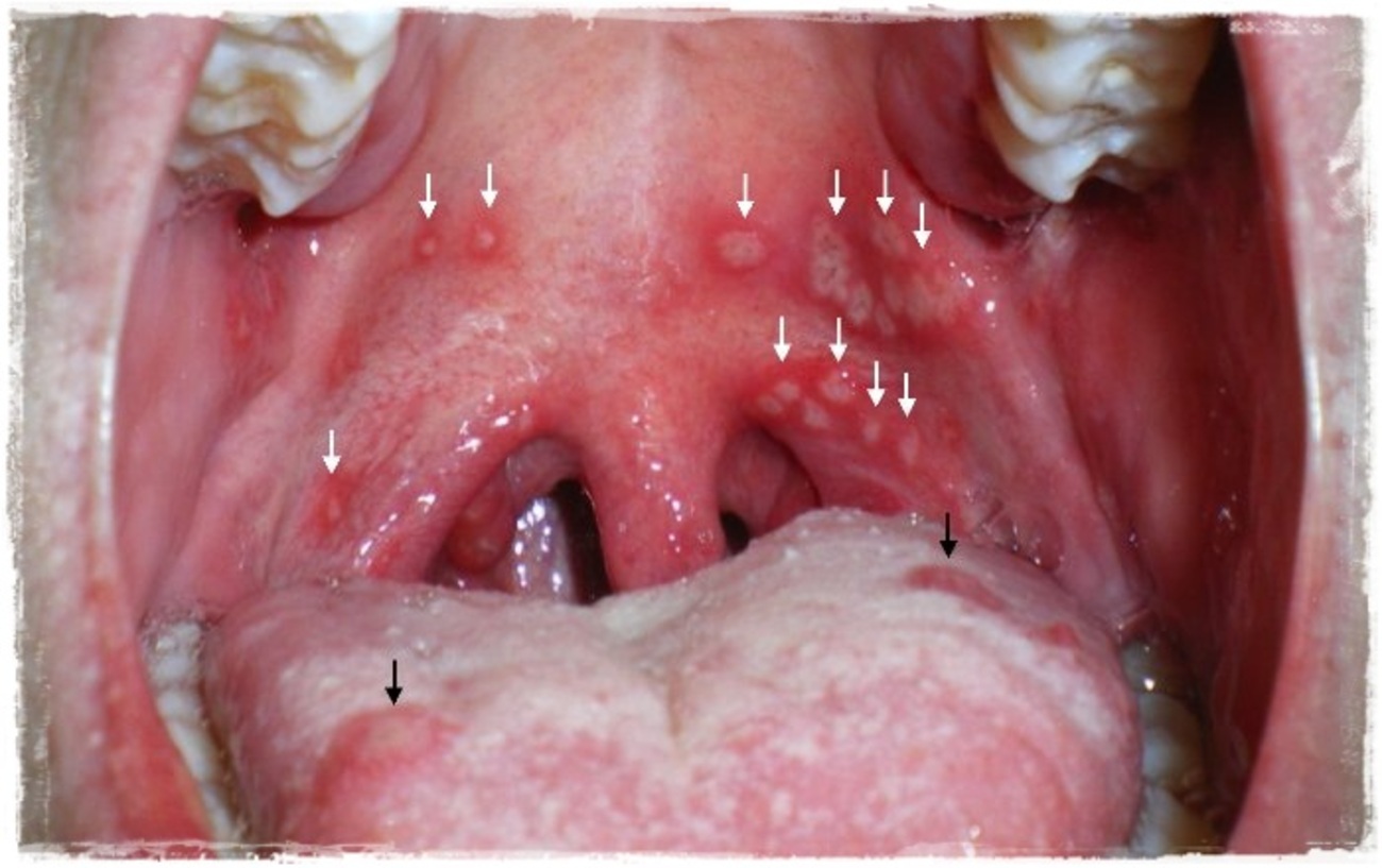 ヘルパンギーナ - つつみこどもクリニック