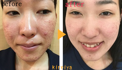 ニキビ跡がファンデーションで隠れずに３重塗りしていましたニキビ跡・クレーター肌専門サロン 横浜 鴨居 横浜市緑区