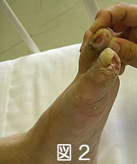 糖尿病による壊疽とは？原因や予防法についても解説 - 府中すみよしクリニック