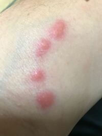 虫刺され吹田市の皮膚科もりはら皮ふ科クリニック
