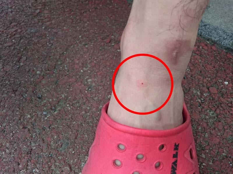 ブヨに刺されて地獄の扉が開いた！治癒までどれだけかかるかな ？ぼるしちのキャンプ＆ライフ