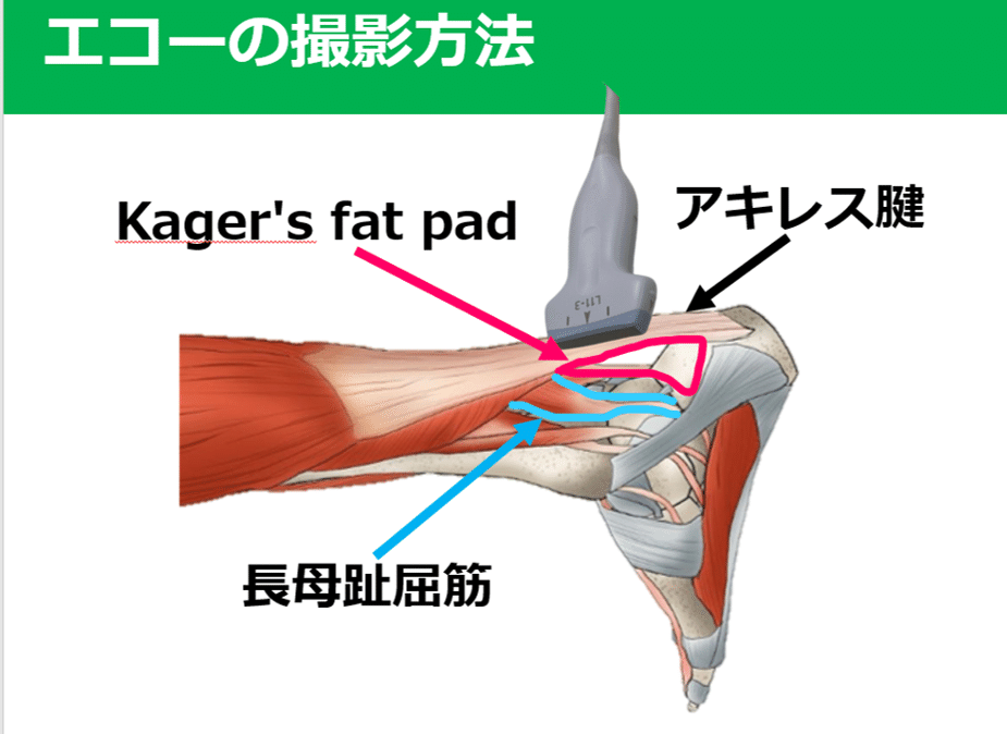 アキレス腱断裂手術後の装具 ストア