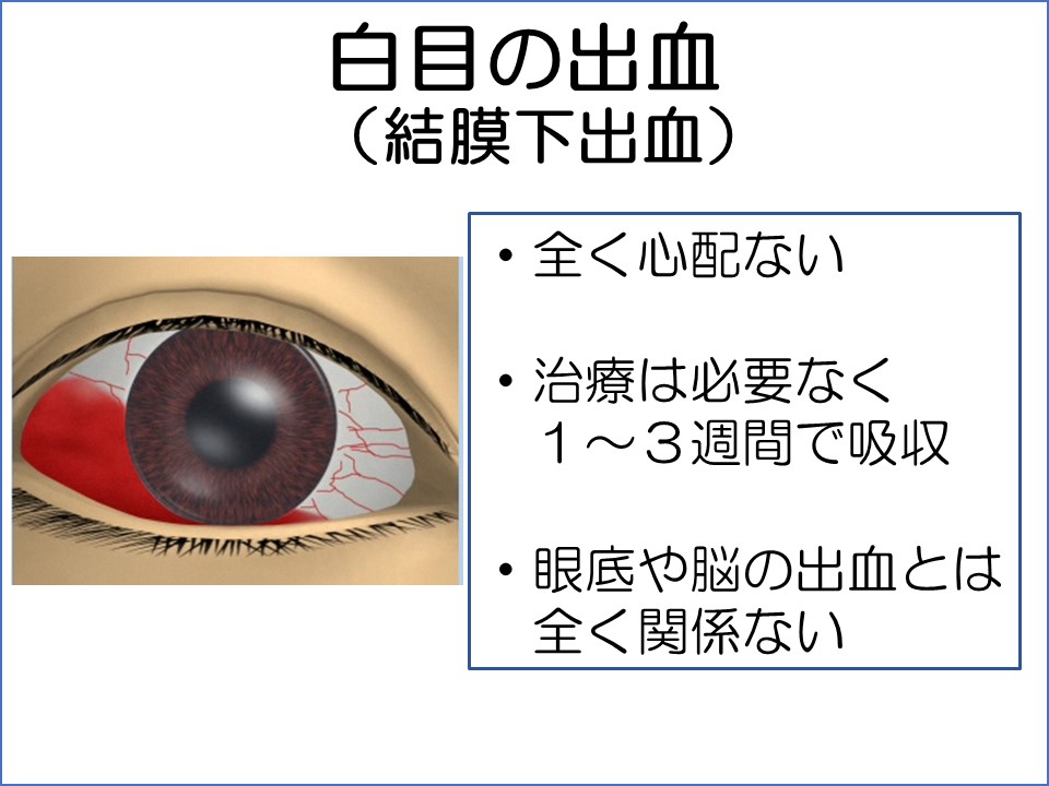 くも膜下出血の前兆・原因・症状 漫画でわかる 横浜もえぎ野クリニック 脳神経外科・脳神経内科横浜市・青葉区・青葉台