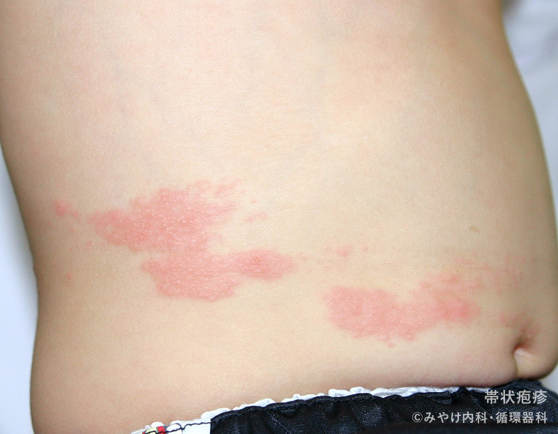 脇の下に違和感？帯状疱疹の初期症状と迅速な対処法 - 中村AJペインクリニック