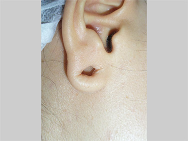 私のピアスの肉芽治療事情の最新版！ 見てね＼ ^o^https:youtu.be TlRbQSi2RE8