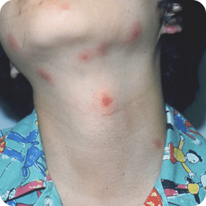 虫刺されの腫れはアレルギーが原因！注意したい虫の種類を確認し、症状がひどくなる前に適切に対処しよう