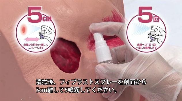 やけど 熱傷 一般社団法人 日本創傷外科学会 一般の皆様へ