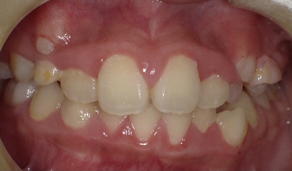 その腫れ、放置しないで！歯茎が腫れる7つの原因と今すぐできる対処法