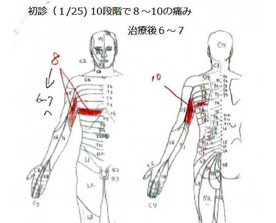 帯状疱疹の激痛体験談 – 私の闘病日記HeartPlus ハートプラス
