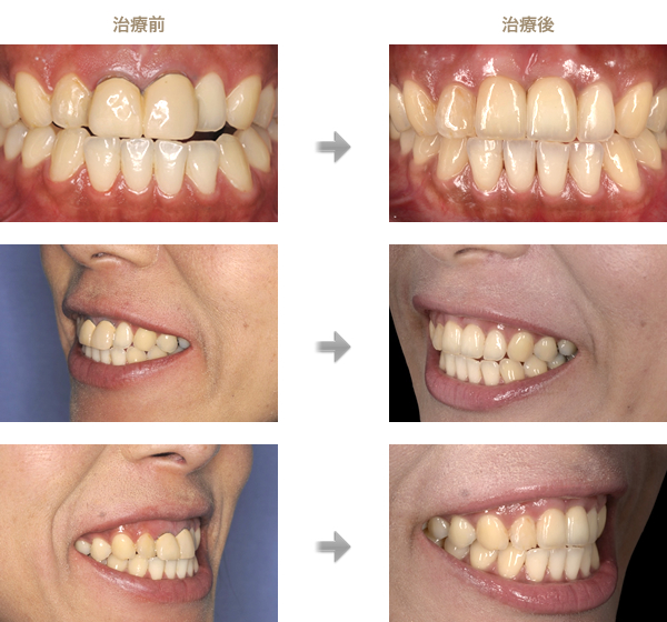 ホワイトニング 前歯を白く世田谷区・用賀デンタルオフィス