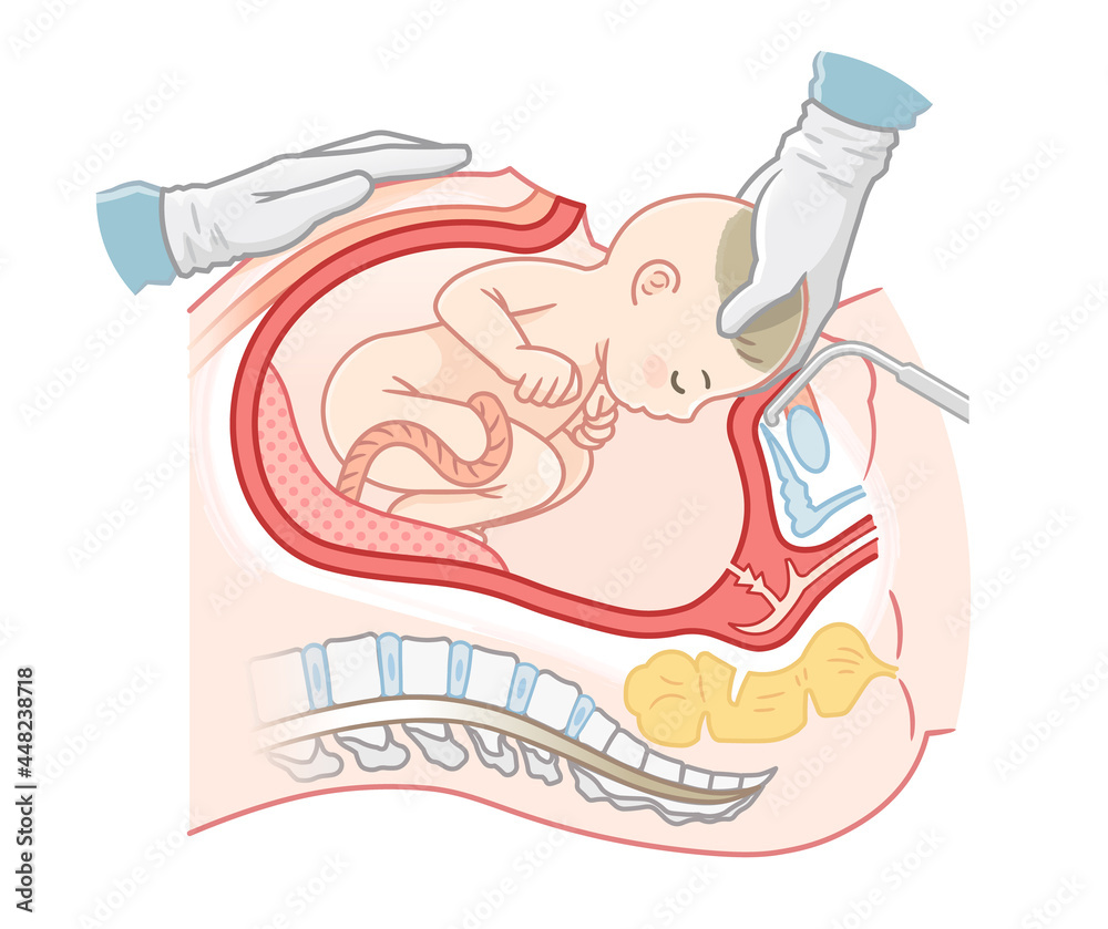 帝王切開の縦切開と横切開部位を表したイラスト🎨 フリー素材 看護roo! カンゴルー