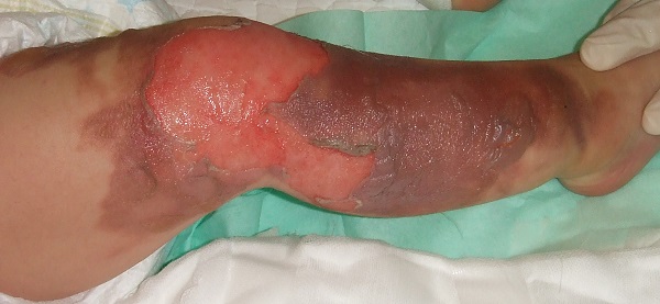 傷・やけどの湿潤治療つかもと内科