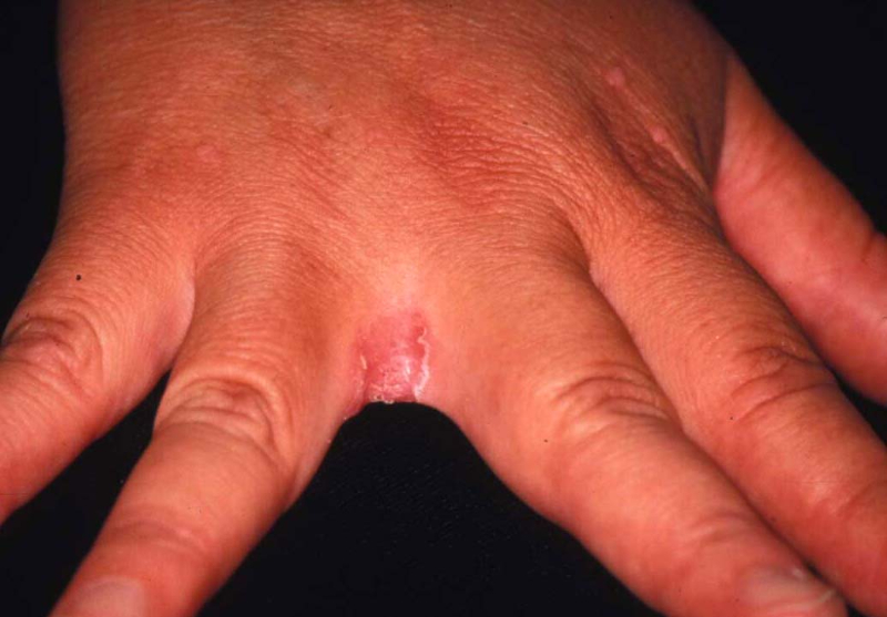 口腔カンジダ症口腔病理基本画像アトラス