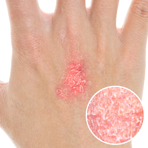 手の指やひらにみられ白いカサカサ野田市 小児科 千葉県 こどもの花粉症 こどもの漢方 喘息 アトピー性皮膚炎 アレルギー 結節性痒疹たんぽぽこどもクリニック