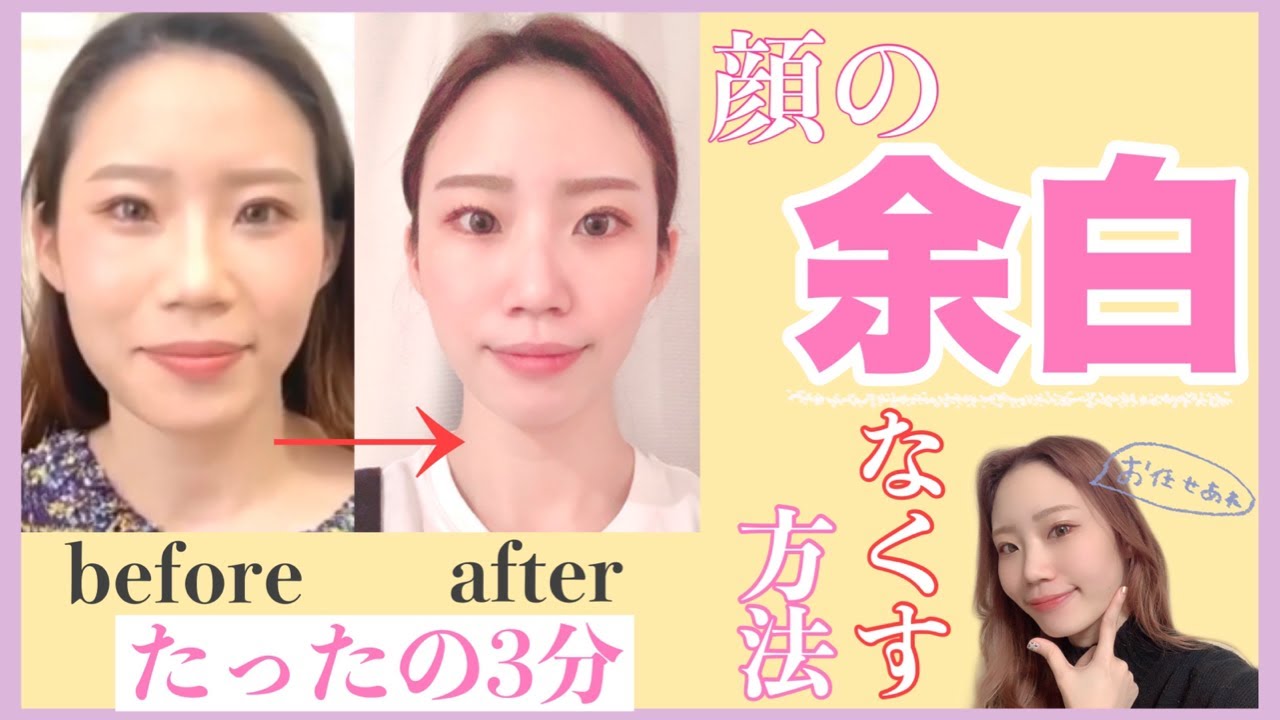 顔の余白が消えて垢抜け成功！1day小顔脂肪吸引の処置前と1ヶ月後の症例です 20代女性美容整形クリニックA CLINIC 公式