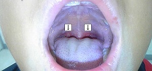 三大夏かぜのひとつ「ヘルパンギーナ」とは？のどコラム龍角散のど研究室
