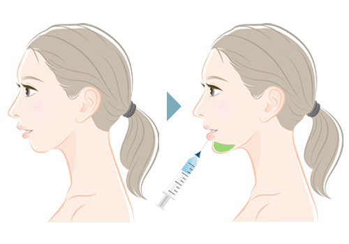 横から見ると顎がない？アデノイド顔貌の治療方法を解説 2025年最新表参道AK歯科・矯正歯科表参道駅より徒歩3分