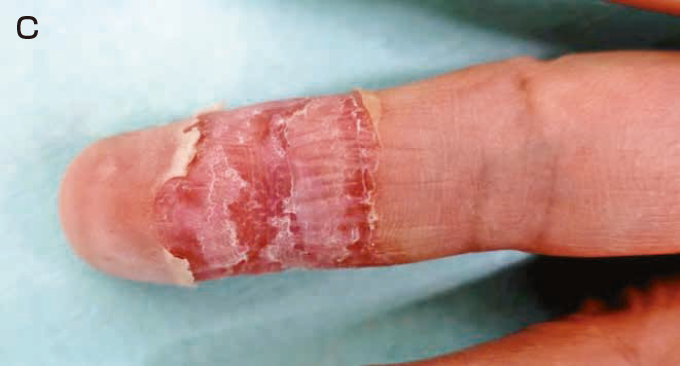 皮膚真菌感染- 柏頓將軍澳皮膚專科中心ProDerm TKO Dermatology Centre