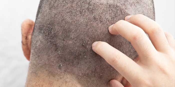 頭皮にかさぶた 頭皮湿疹 ができたので市販薬のメディクイックHを買ってみた