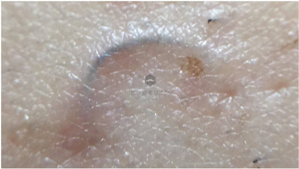 実体験 中学生からヒゲを抜き続けたら薄くなった話 30代まで