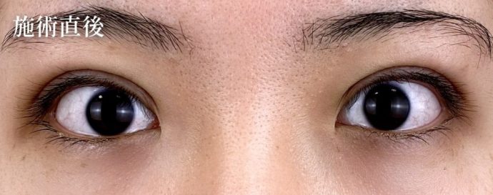 目の下のクマ・たるみ手術後の内出血で色素沈着が生じた症例のご紹介