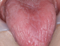 口腔カンジダ症 ➀若い人の口腔カンジダはHIVも疑う。②舌が白くならないカンジダもある