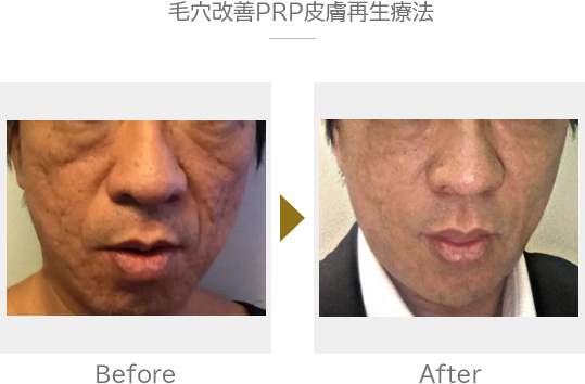 開き毛穴・鼻のボコボコに悩み、ダーマペンやエクストラクションを繰り返しされていた40代女性のお客様。毛穴ケア専門サロン AmélioBeauté所属・毛穴ケア専門サロン アメリオボーテの美容サロンカタログ 20230514160206 ミニモ