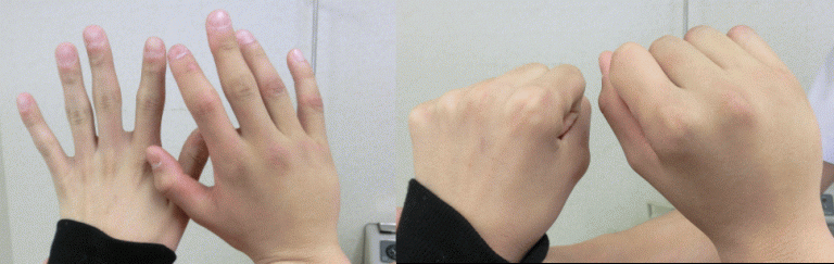 膝の打撲と挫傷