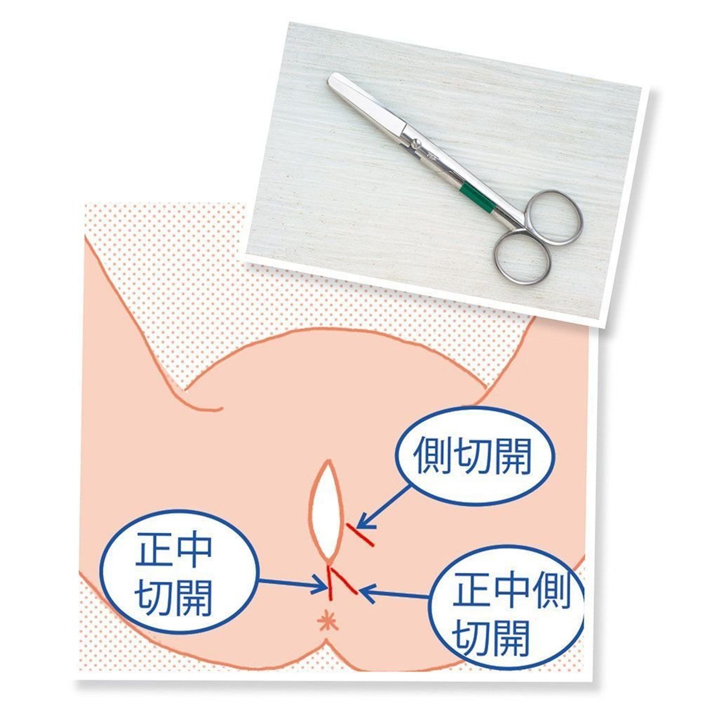 トラブル＆ケア日常のトラブル過剰肉芽の物理的切除NPO法人PDN