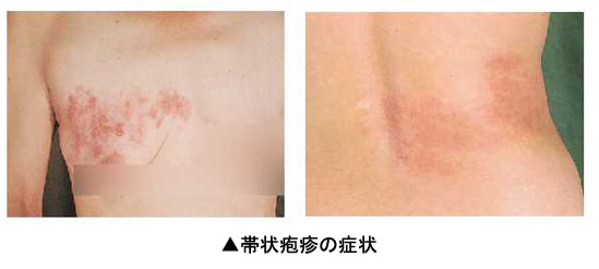 眼科コラム大津市堅田 かたた の「ひの眼科クリニック」白内障手術・緑内障