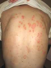 乾癬の新常識：関節炎を合併しやすい臨床的特徴プライマリ・ケア医が知っておくべき クイズで学ぶ 皮膚科診療の“新常識” 4– 日本医事新報社